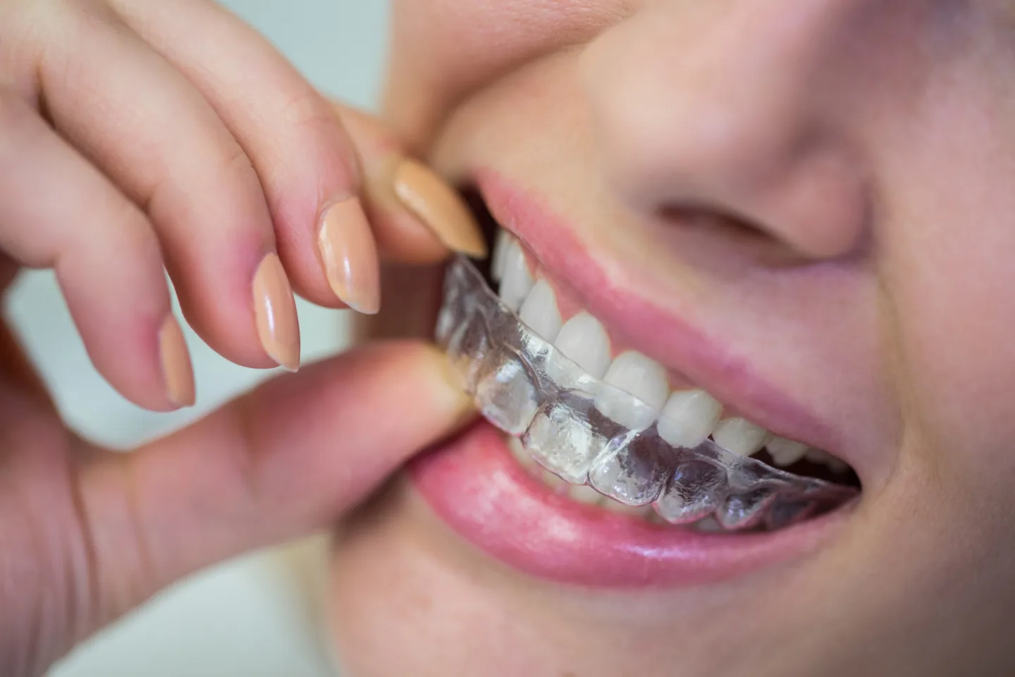 Femme utilisant un appareil orthodontique amovible.